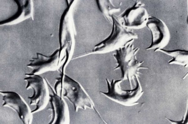 Globules Rouges Drépanocytaires En Absence D'oxygène