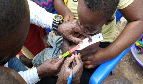Malnutrition NK RDC